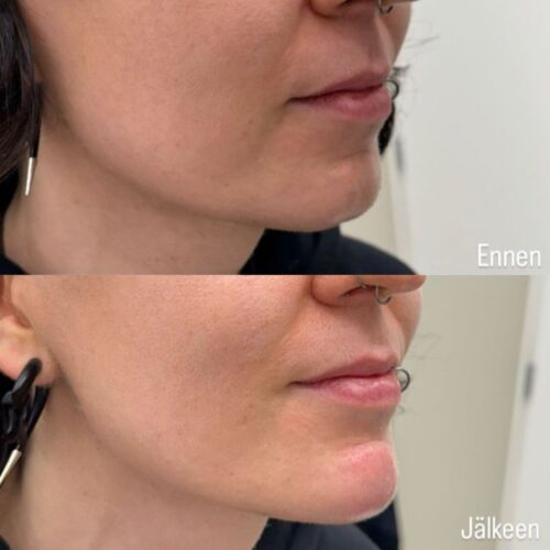 leuan muotoilu botox tayteaine