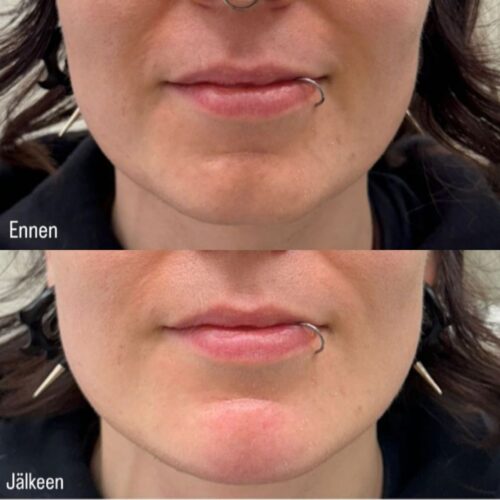 leuan muotoilu tayteaine botox