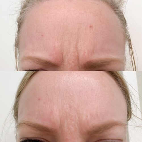 Botox Helsinki, ennen jälkeen botox hinta