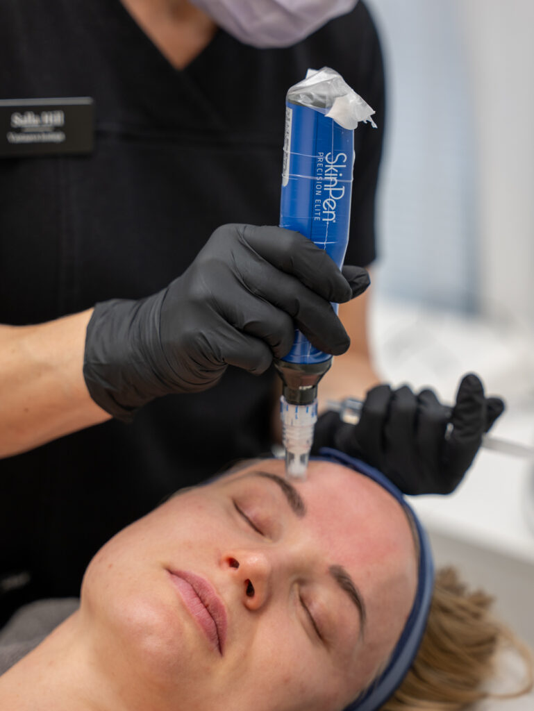SkinPen microneedling