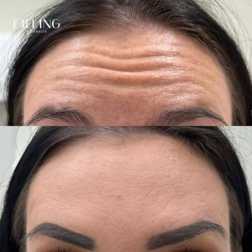 botox helsinki botox otsaan