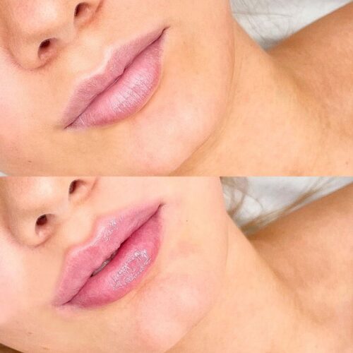 juvederm kokemuksia