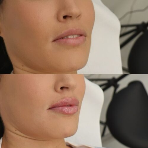 restylane kokemuksia ninia nyman