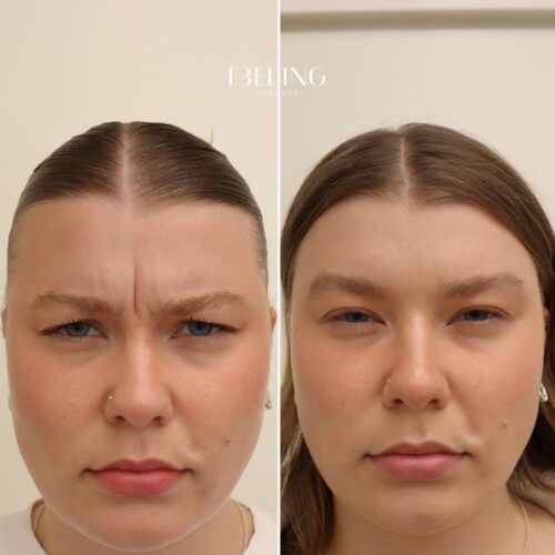 botox helsinki