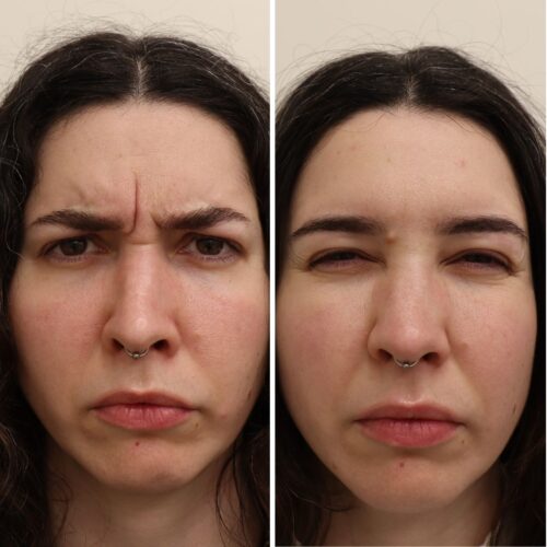 sibeliusryppy botox
