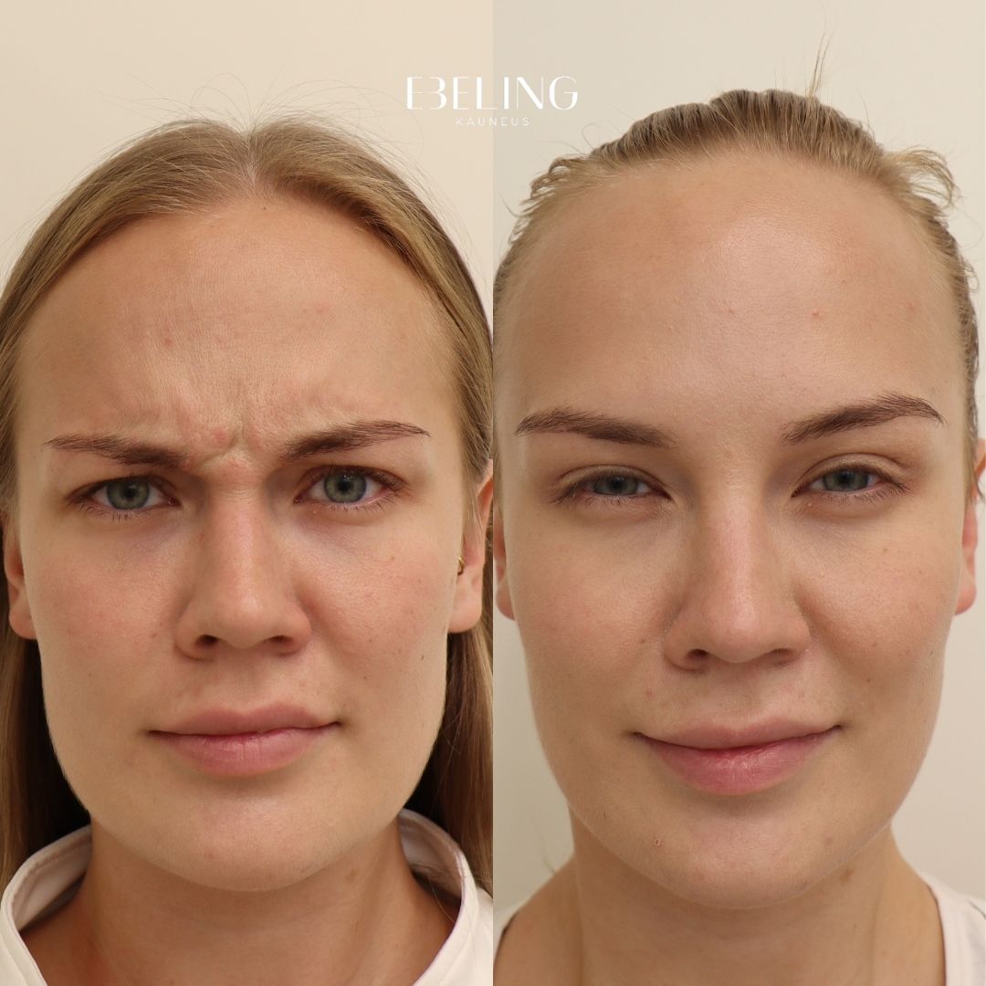 sibeliusryppy botox baby botox helsinki