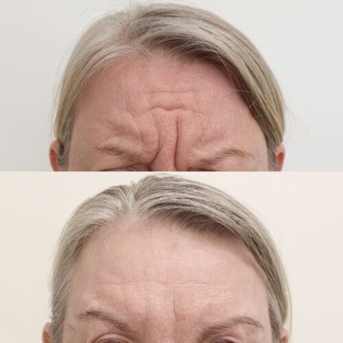 botox helsinki botox otsaan