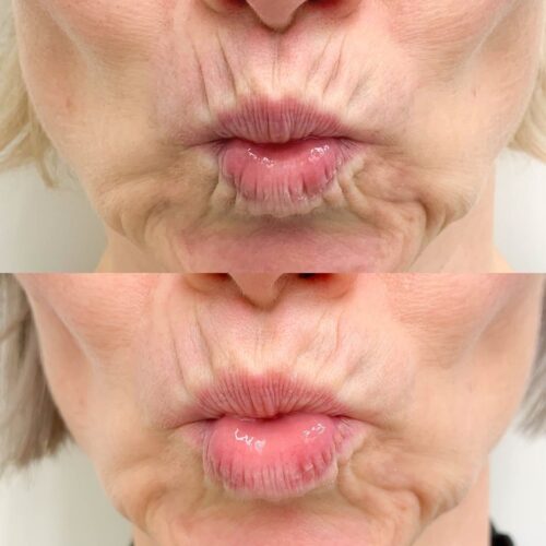 tupakkarypyt botox