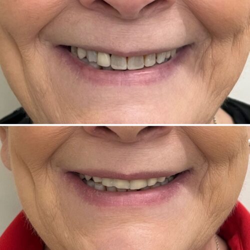 botox helsinki (1)
