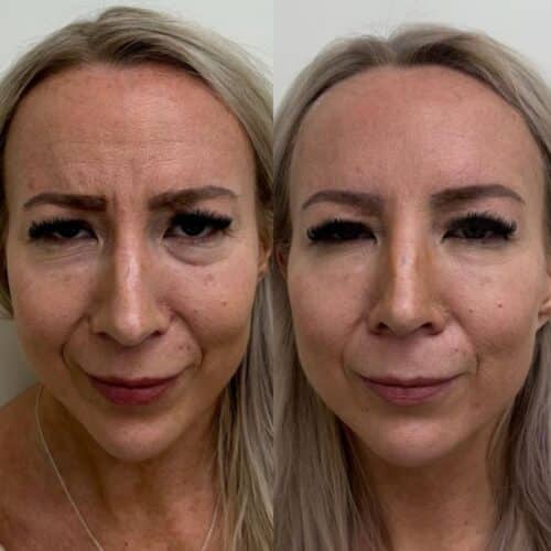 botox helsinki