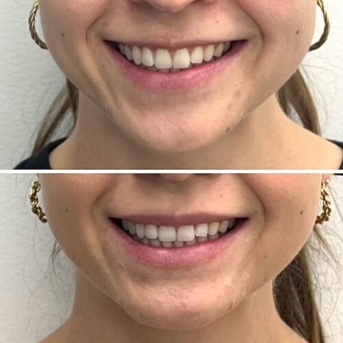 botox lip flip botox helsinki