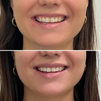 Botox lip flip