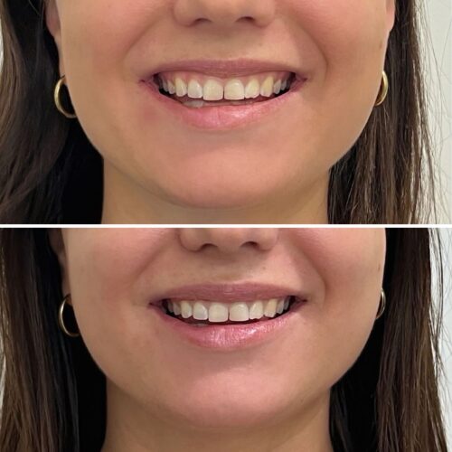 botox lip flip botox helsinki