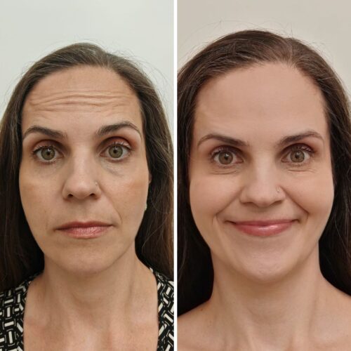 Botox kokemuksia juuli korkeila rypyt pois