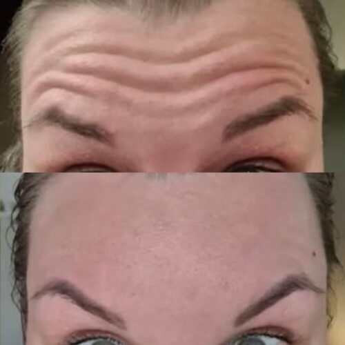 botox otsaan