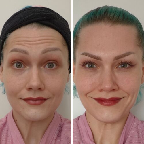 botox otsaan (3)