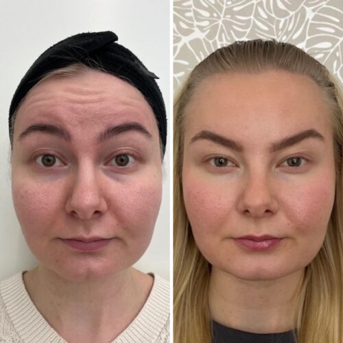 botox otsaan