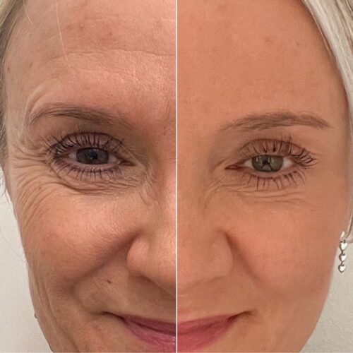 Silmäkulmat naururypyt harakanvarpaat botox