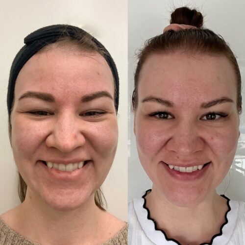Silmäkulmat naururypyt harakanvarpaat botox