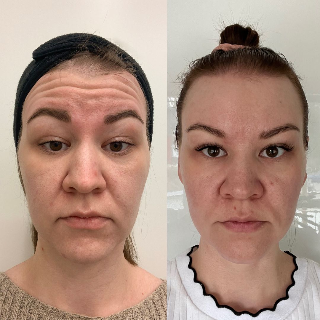 Botox-malli ennen hoitoa ja hoidon jälkeen.