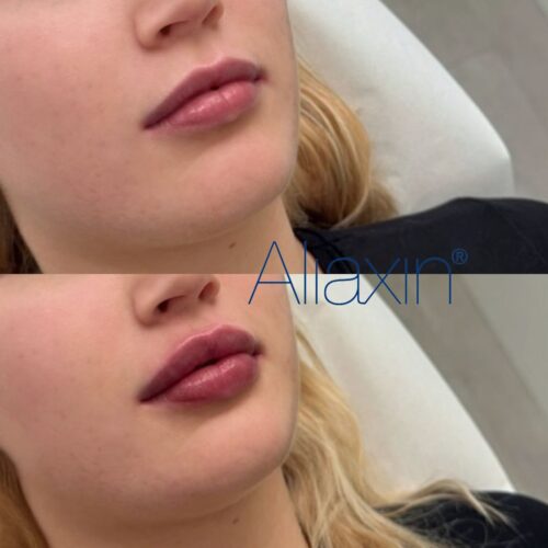 Aliaxin huulet