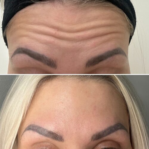 Botox helsinki