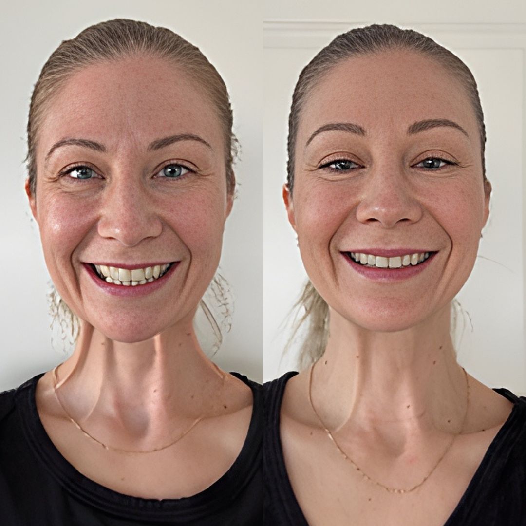 Nefertiti lift full face botox