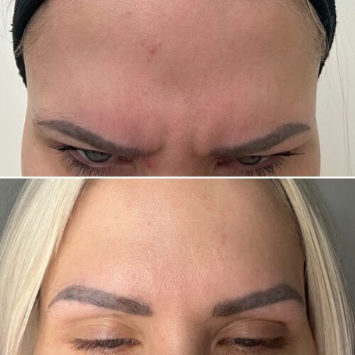 botox vantaa