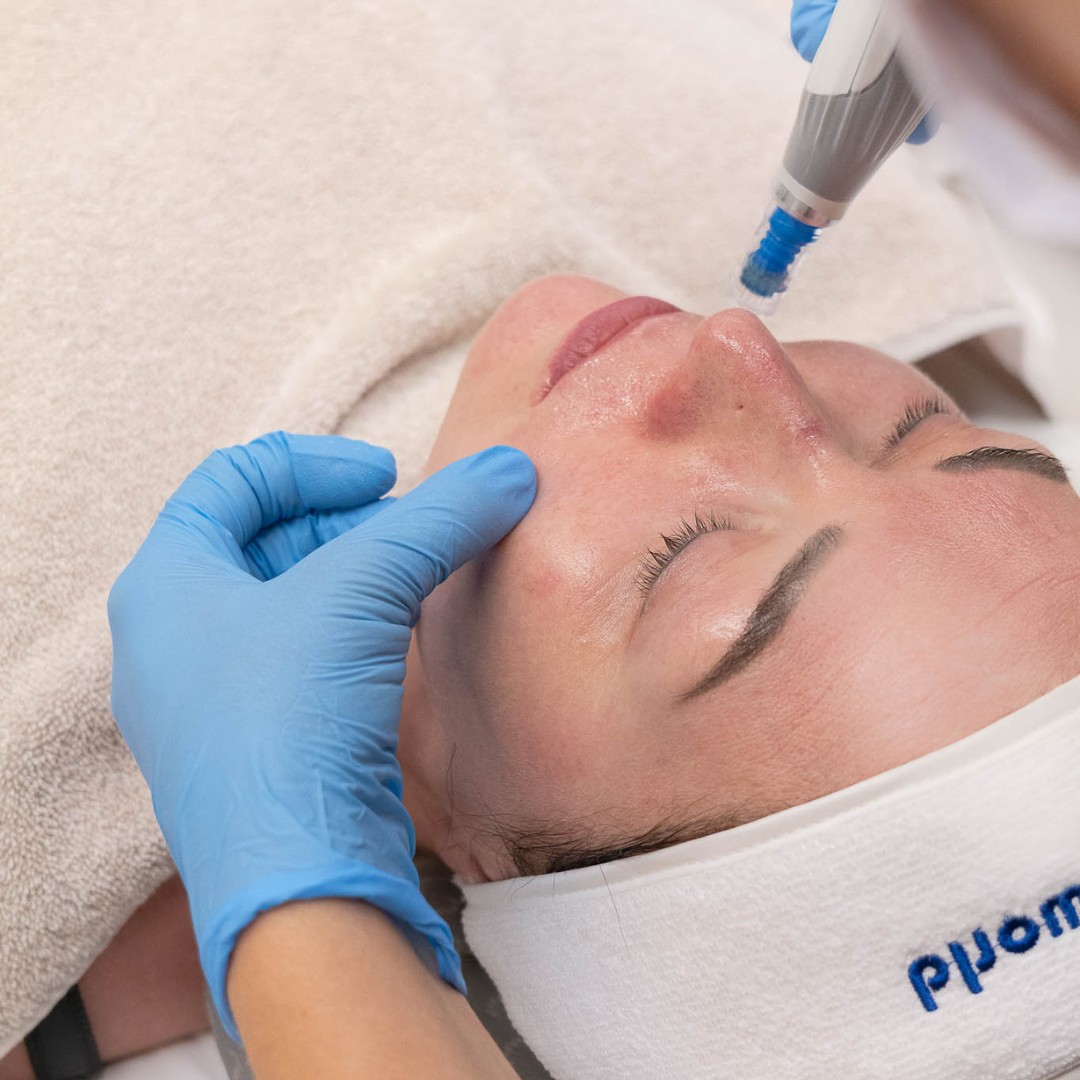 Dermapen4 -hoidot nyt saatavilla Ebeling Kauneuden Tikkurilan klinikalta