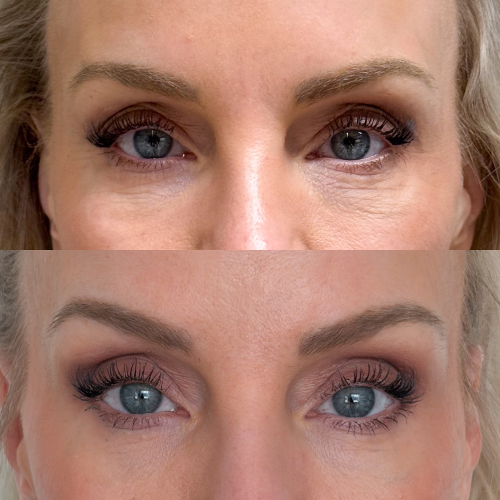 Profhilo for under-eye area, Viscoderm Skinko e for the skin around the eyes