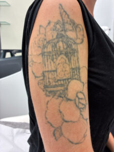 tatuoinnin poisto laser ennen
