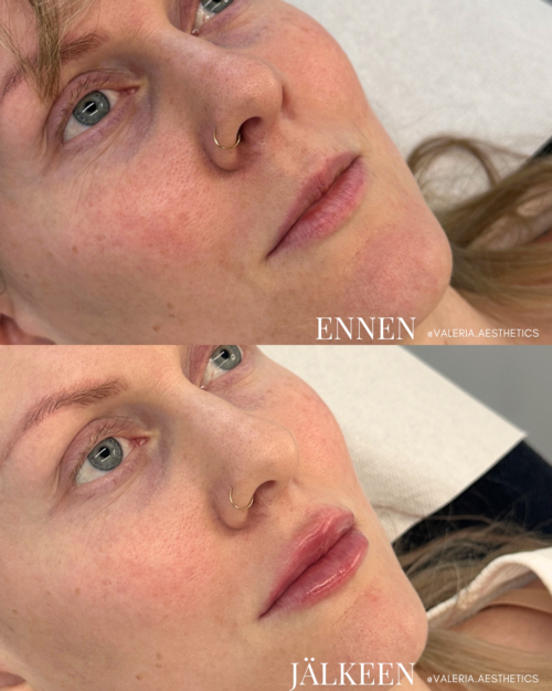 before_after_lips