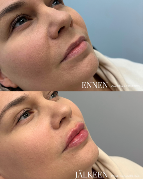 before_and_after_lip_filler