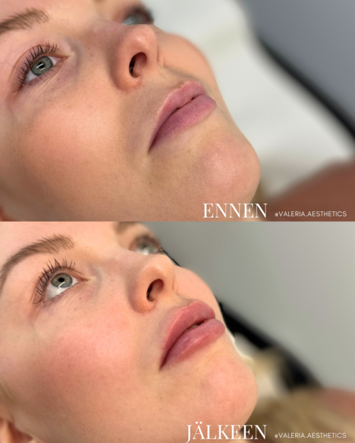 lip_filler_helsinki