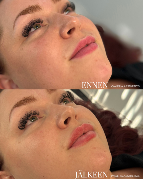 lip_filler_kalasatama
