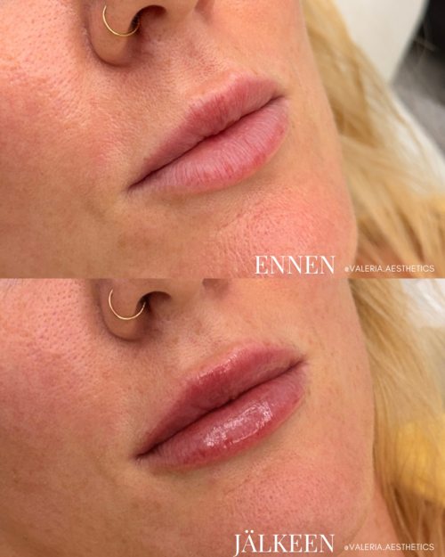 valeria_before_and_after_lips