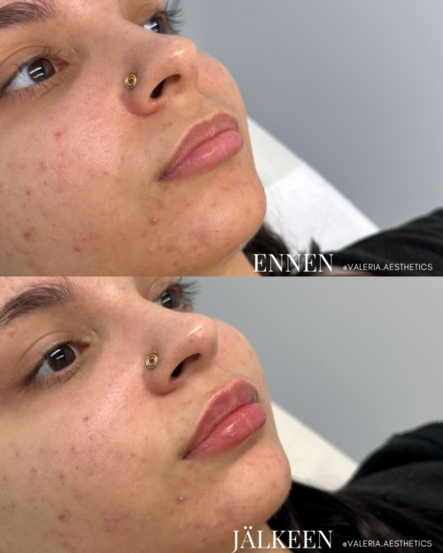 valeria_farm_lip_filler_helsinki