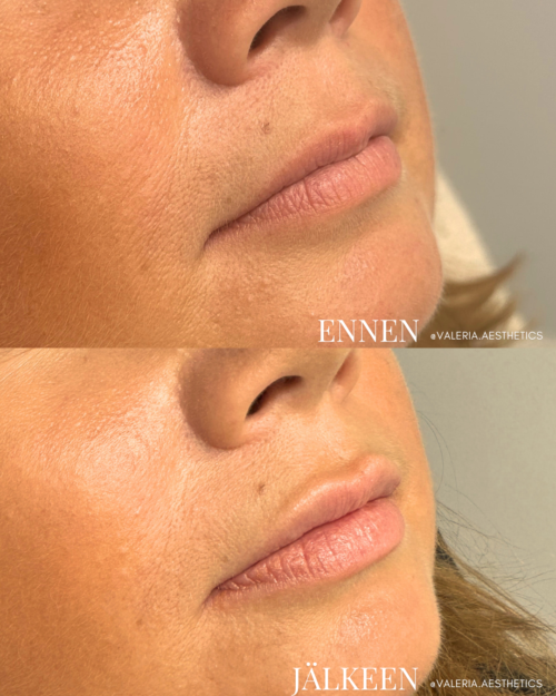 valeria_färm_lip_filler_kalasatama