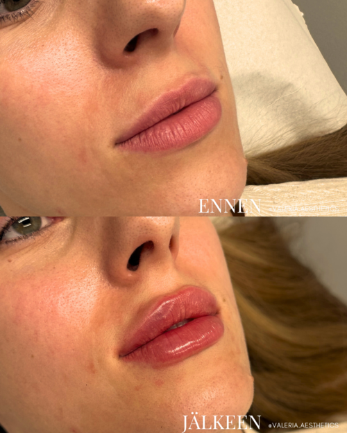 valeria_färm_experiences_with_lip_fillers