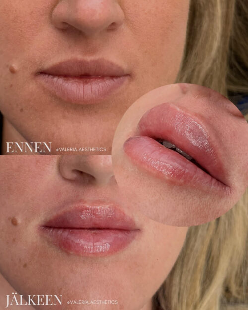 valeria_lip_filler